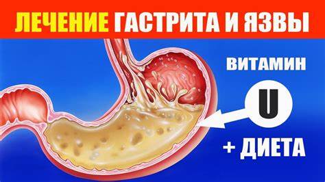 Гастрит и Язва Желудка. Лечение Профилактика Диета Картинка - Гастрит и Язва Желудка. Лечение Профилактика Диета