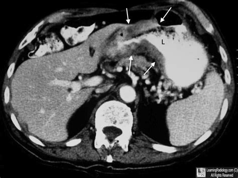 Learningradiology Carcinoma Of The Stomach