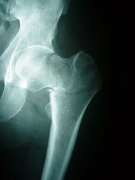 Controversy exists as to whether it is necessary to perform reduction and fixation of this fragment. Concomitant ipsilateral subcapital and intertrochanteric ...