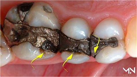How Do Silver Fillings Work Moved History Image Bank