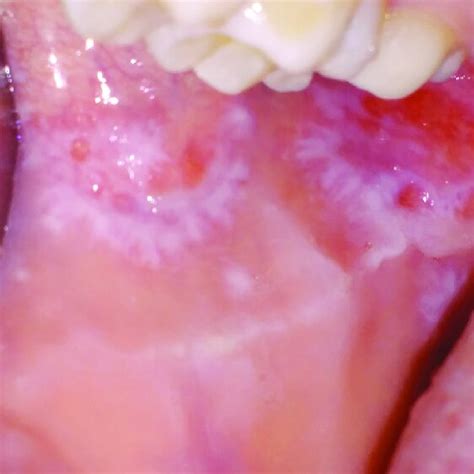 Oral Lichen Planus Reticular Form Author´s Archive Download