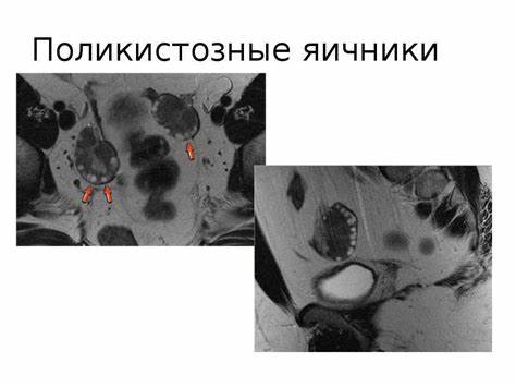 Поликистоз яичников и диета Поликистоз яичников | ДРАЙВ Поликистоз яичников | ДРАЙВ Поликистоз яичников и диета