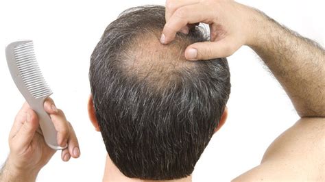 How To Reverse Male Pattern Baldness Alopecia Areata Treatment