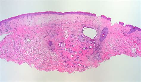 Syringoma And Lichen Sclerosus Vulva As With The Majority O Flickr