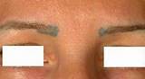 Skin Discoloration After Laser Treatment