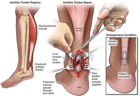 Surgery for chronic achilles tendon tears. Achilles Tendon Surgery NYC | Achilles Tendon Tear Repair