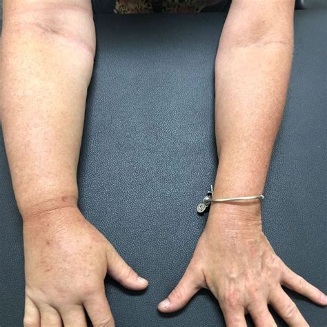 Lymphoedema Management Mackay Upper Limbs And Things