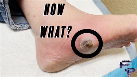 Infected Blister Treatment Youtube