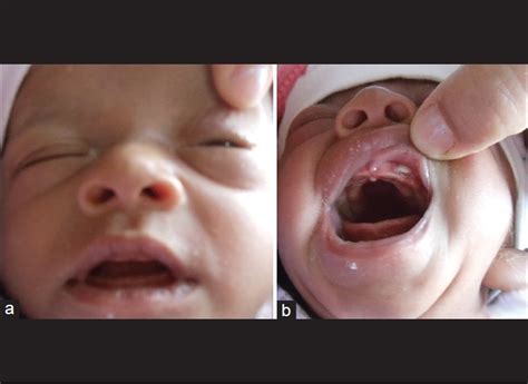 Orbital Cellulitis In A Neonate Of The Tooth Bud Origin A Case Report