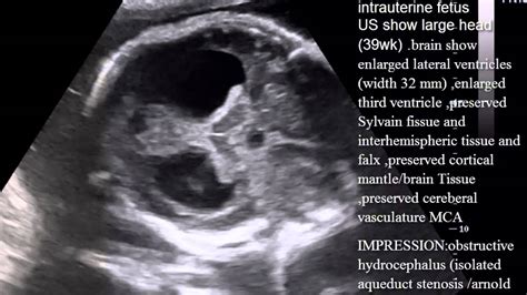 Case 134 Fetal Obstructive Hydrocephalus Youtube