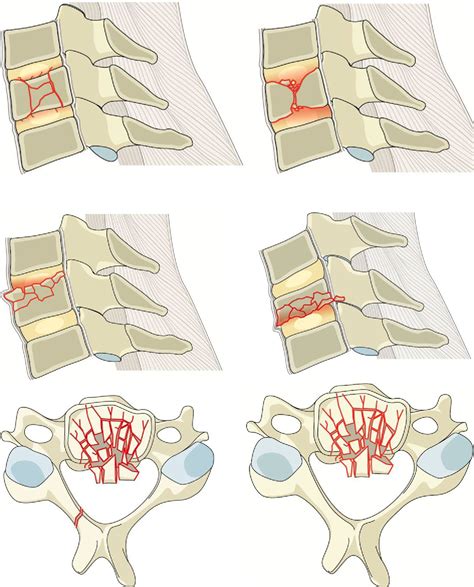 Aospine Subaxial Cervical Spine Injury Classification System Semantic