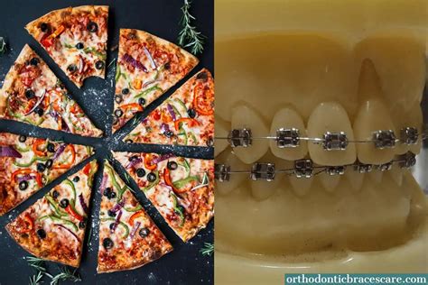 Can You Eat Pizza With Braces 7 Easy Tricks Orthodontic Braces Care