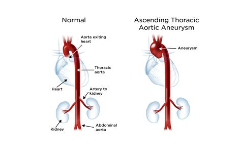 Aortic Pathologies Explained Healthy Lifestyle Aortic