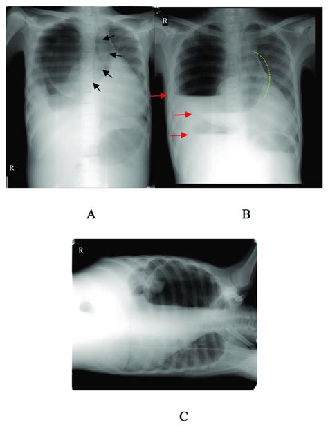 Chest Radiograph With Positions A Ap Supine B Erect C Left Download Scientific Diagram