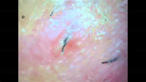Ingrown Hair Removed From Pimple YouTube YouTube