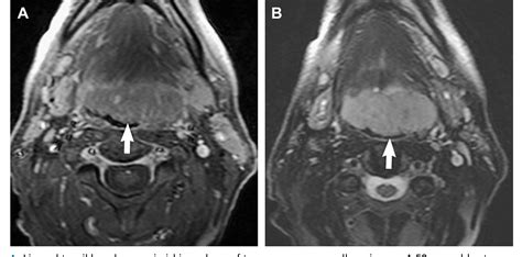 Figure 4 From Imaging Hodgkin And Non Hodgkin Lymphoma In The Head And