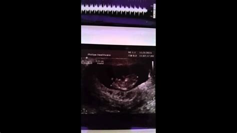 10 Weeks Ultrasound Boy Or Girl Youtube