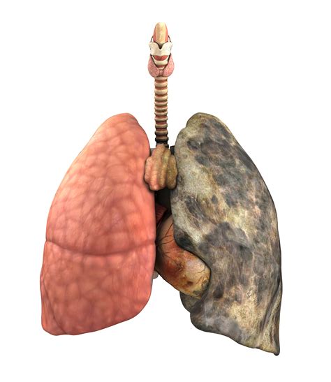 New Therapeutic Approach For Advanced Lung Disease Wales Healthcare