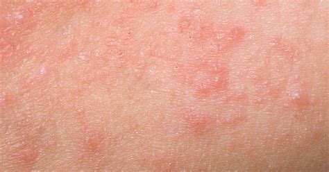 What Is Keratosis Pilaris And Why Does It Look Like Body Acne Huffpost