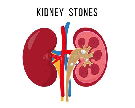 Kidney Stone Disease Human Diseased Urinary System Stock Vector