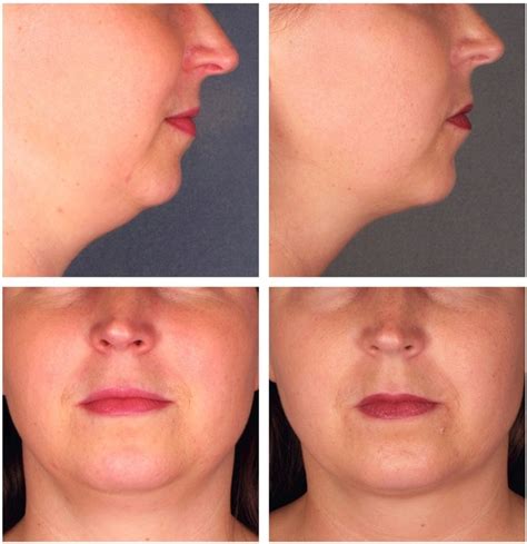 Kybella Injections Double Chins Photo Las Vegas Nevada Before After