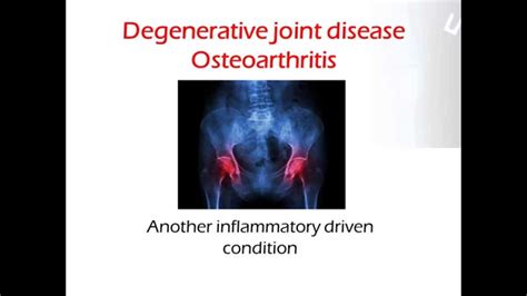 Degenerative Joint Disease Osteoarthritis Youtube