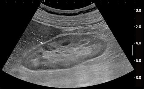 Ultrasound Imaging Of Abdominal Sarcoidosis State Of The Art