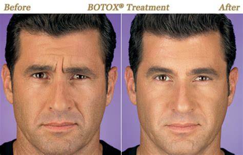 Mens Aesthetics Boston Botox And Bro Tox