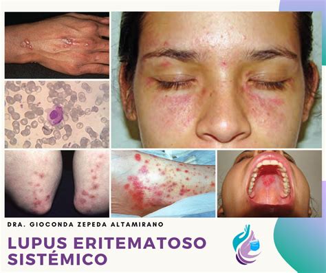 🔷el Lupus Eritematoso Sistémico Es Una Enfermedad Inflamatoria Crónica