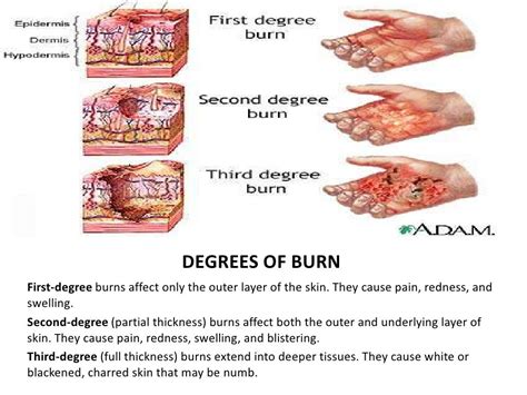 Burn Injury