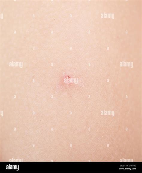 Insect Bite On Human Skin Stock Photo Alamy
