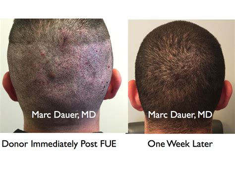 1 Week After Fue Hair Transplant To Beard Marc Dauer Md Hair