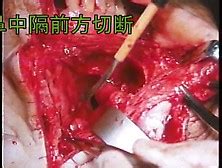 Low Anterior Resection And Total Mesorectal Excision Coloanal My Xxx