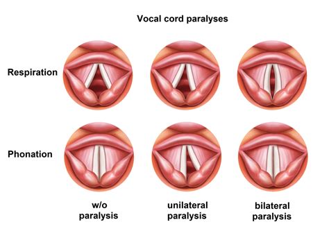 Vocalcorddysfunctions Vocal Cord Dysfunctions Information