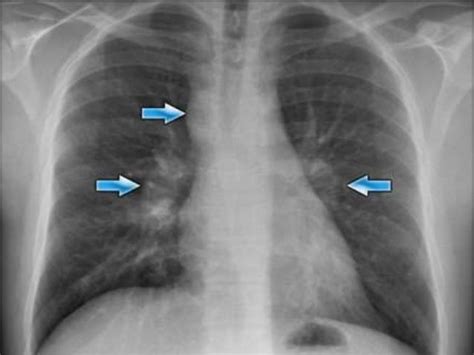 Signs In Chest Xray