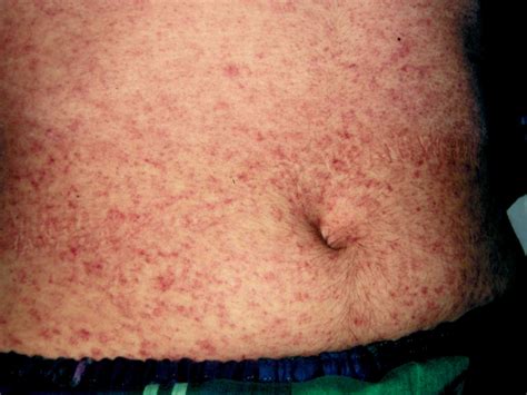 Exanthem Rash Pictures Treatments And More