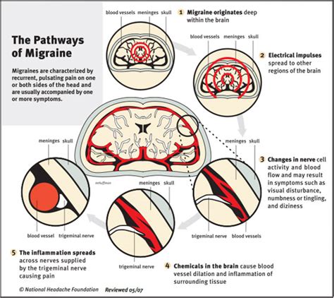 Neural Pathways Of Migraine New Life Outlook Migraine