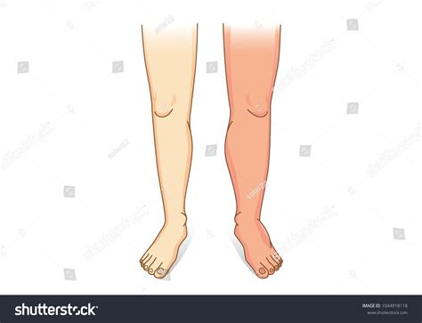 human leg swelling front view illustration stock vector royalty free 1044918118 shutterstock