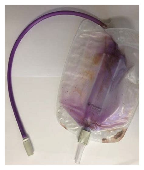 Purple Discoloration Of Urine Bag And Tubing Coming From Suprapubic