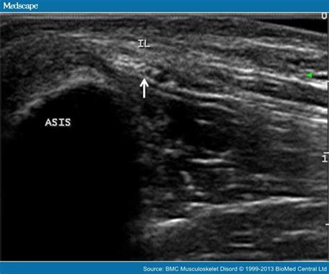 Lat Femoral Cutaneous Nerve Ultrasound