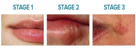Cold Sore Stages Pictures Know How To Get Rid Of Cold Sore