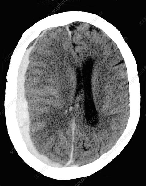 Subdural Haematoma Ct Scan Stock Image C Science Photo Library