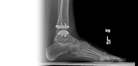 Ankle Joint Replacement San Antonio Tsaog Orthopedics