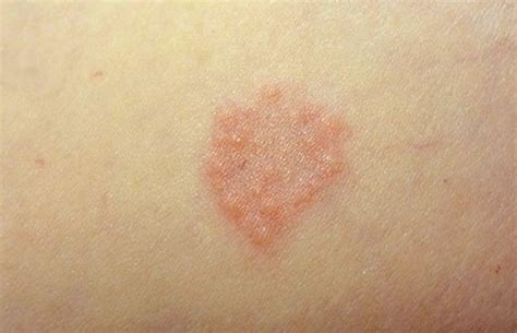 1000 Images About Skin Issues On Pinterest Sun Eczema Remedies And