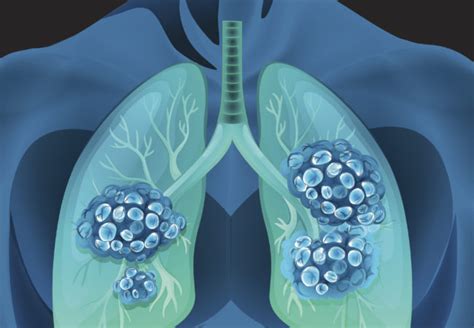 Lung Nodule Gilbert Respiratory Associates Center For Respiratory