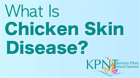 What Is Chicken Skin Disease Video Youtube