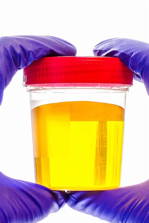 Green Urine Covid