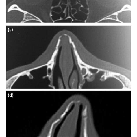 Nasal Fracture