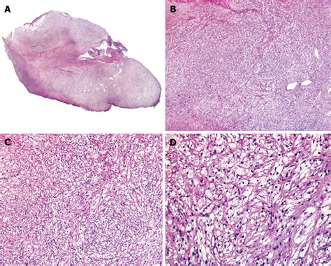 Figure 2 From Cutaneous Perivascular Epithelioid Cell Tumors A Review
