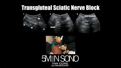 5 Min Sono Transgluteal Sciatic Nerve Block Core Ultr